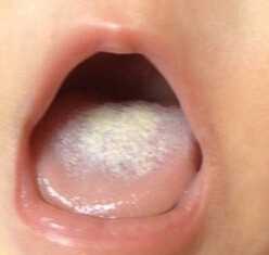 宝宝的舌苔要不要清洁呢？